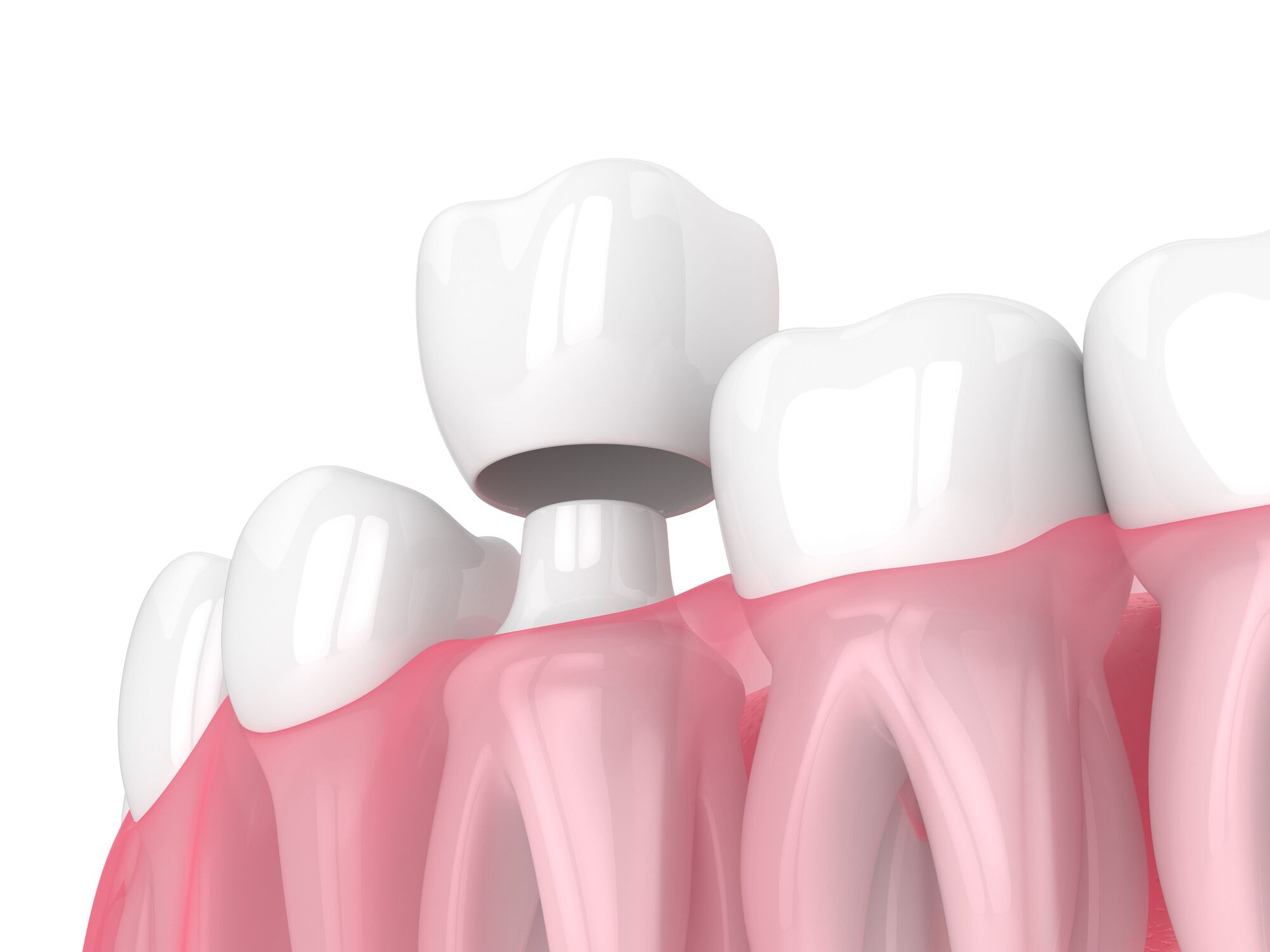 Dental Crown for Tooth Repair in Greenville SC